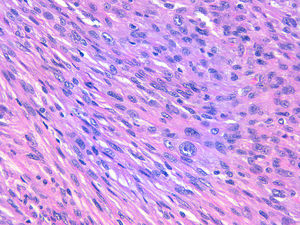 Detalle de la mezcla de células epitelioides y fusiformes en un fibroxantoma atípico (H&E, 40x).