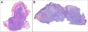 a) Fibroxantoma atípico de morfología polipoide. Tumoración dérmica bien delimitada sin invasión de tejido celular subcutáneo (H&E). b) Sarcoma pleomórfico dérmico observado con lupa. Tumoración extensa con afectación de borde profundo (H&E).