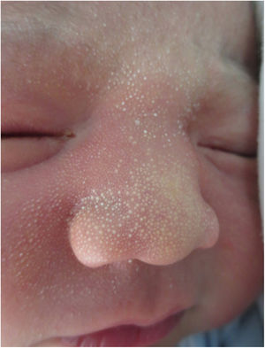 Hiperplasia sebácea.