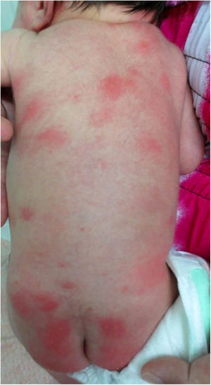 Eritema tóxico neonatal.