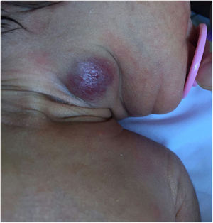 Hemangioma congénito.