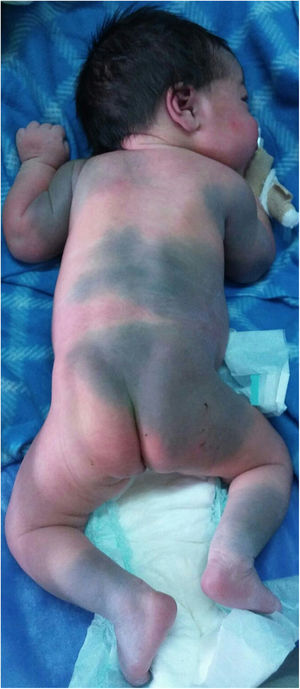 Melanocitosis dérmica aberrante.