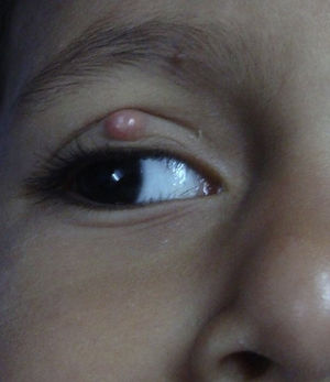 Lesión de molusco en la 1.ª visita.