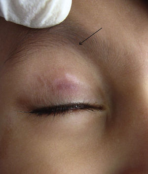 Respuesta completa observada después de 4 aplicaciones de cantaridina con una hipopigmentación postinflamatoria leve.