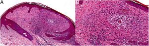 Fibrosis y aumento del colágeno dérmico con disposición perivascular y en haces paralelos. Hematoxilina-eosina, 100x (A) y 200x (B).
