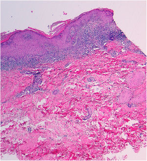 H-E×40. Intensa dermatitis de interfase de tipo liquenoide.