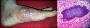 Actinomicetoma del pie. (A) Tumefacción con abundantes senos de secreción en el pie derecho. (B) La histopatología mostró infiltrado linfohistiocitario polimorfo con grano basófilo característico, rodeado de material eosinófilo (tinción hematoxilina-eosina x100).