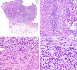 A) Panorámica de HF. B, C y D) A mayor aumento, haces y espirales de tejido fibroblástico y mesenquimal inmaduro. HF: hamartoma fibroso.