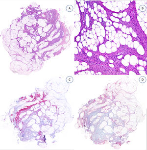 A) Panorámica de una extirpación simple de un HFI subcutáneo. B) A mayor aumento, tejido graso y fibroblástico. C) La actina del músculo liso decora el tejido fibroso maduro. D) Áreas de positividad para CD34, marcando componente inmaduro. HFI: hamartoma fibroso de la infancia.