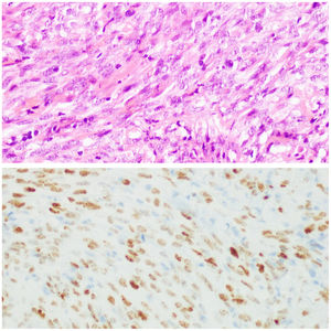 Examen histológico característico del sarcoma de Kaposi (tinción hematoxilina-eosina, ×400) y tinción inmunohistoquímica para HHV8 (×400).