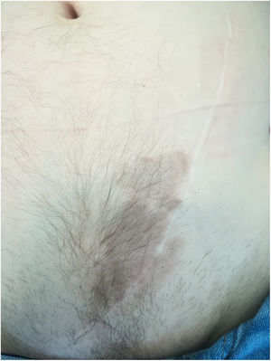 Regresión del sarcoma de Kaposi después del cambio de tacrolimus a everolimus.