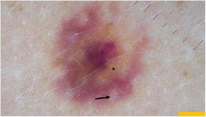 Dermatoscopia (DermLite 4®). Estructura homogénea rojo-violácea, rodeada de halo periférico bifásico. El primer halo más interno color amarillento-anaranjado (*) y un segundo halo externo color rojizo, respetando las aperturas foliculares (flechas).