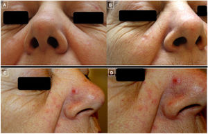 Fotos clínicas que evidencian la evolución de las lesiones (A-D). Las fotos A y B muestran la buena respuesta de las lesiones de ambas mejillas tras el tratamiento con rituximab intralesional. Las fotos C y D, en cambio, muestran el empeoramiento y la aparición de una pápula eritematosa bien delimitada en vertiente nasal (D) sobre una piel con tendencia al enrojecimiento y presencia de telangiectasias en mejillas y punta nasal que confiere un aspecto rosaceiforme.