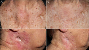 Imagen clínica de tumoración preesternal y de ángulo mandibular derecho antes (A) y tras 4 ciclos de pembrolizumab (B). Se aprecia el cierre de la fístula tumoral en el ángulo mandibular derecho tras el tratamiento (B inferior).