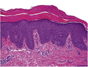 Ortoqueratosis alternando con focos de paraqueratosis (H-E, ×40). La epidermis presenta regular acantosis e hiperplasia psoriasiforme. Dermis con escaso infiltrado inflamatorio.