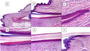 Anatomía histológica de la uña normal. A) Anatomía microscópica de la uña normal en un corte longitudinal. B) Detalle de la matriz ungueal y el eponiquio. C) Repliegue entre la matriz proximal y el eponiquio. D) En la porción inferior, se aprecia la típica queratinización sin capa granulosa de la matriz para formar la lámina con un aspecto similar a la queratinización tricolémica. En la porción superior, se aprecia el eponiquio con su queratinización ortoqueratósica característica. E) Detalle del lecho ungueal con su típica epidermis aplanada sin capa granulosa cubierta directamente por la lámina. F) Detalle del hiponiquio con una epidermis con queratinización ortoqueratósica de características similares a las del resto de la piel acra normal (no subungueal).