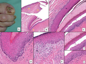 Melanoma subungueal. A) Lesión pigmentada subungueal que genera una importante distrofia ungueal, con destrucción parcial de la lámina. Se observa una evidente pigmentación en el lecho expuesto, en el hiponiquio y en el pliegue ungueal proximal (signo de Hutchinson). B) Panorámica de la biopsia ungueal longitudinal (x4), en la que ya se adivina un aumento de pigmento en la matriz, así como focos dispersos de infiltrado inflamatorio acompañante (flechas). C) A mayor detalle (x100) la matriz ungueal muestra una proliferación lentiginosa de células vacuoladas (melanocitos), con ascenso suprabasal marcado, e incluso, incorporación dentro de la lámina ungueal de algunas células. Esta proliferación lentiginosa afecta también al eponiquio. D) A mayor detalle (x200) se aprecia una proliferación de melanocitos atípicos, con ascenso suprabasal y que ha invadido toda la matriz y se extiende ya hacia el eponiquio. E) Detalle (x200) del pliegue ungueal proximal. La proliferación melanocítica se ha extendido ya hasta la piel proximal al eponiquio. De nuevo, se observa una proliferación lentiginosa de melanocíticos atípicos, con presencia de células atípicas ya en la dermis papilar e infiltrado inflamatorio acompañante. Por tanto, este melanoma es inicialmente invasor. F) Detalle (x200) de ascenso suprabasal de células atípicas, algunas de las cuales se están incluyendo en la lámina ungueal. G) Detalle (x200) de la matriz ungueal: ascensión a capas suprabasales de melanocitos atípicos.