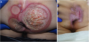 a) Aspecto inicial de las UP del caso 3. b) Íntegra reepitelización de las úlceras del caso 3 transcurridos 3 meses.