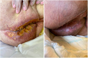 a) Aspecto inicial de las UP del caso 5. b) Resolución de las UP del caso 4 tras 6 semanas aplicando antibiótico tópico.