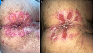a) Aspecto inicial de las UP del caso 6. b) Mejoría de las UP del caso 6 tras 2 semanas sin aplicar la PH.