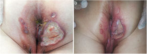 a) Aspecto inicial de las UP del caso 8. b) Caso 8: evidencia de la mejoría y casi completa resolución de las UP tras 5 meses sin aplicar la PH.
