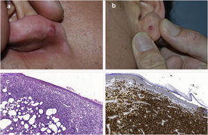 A y B) Pápulas rojizas en ambos lóbulos auriculares localizadas en los orificios de los pendientes; C) Tinción H&E ×100, denso infiltrado linfocitario dérmico con muy escaso epidermotropismo; D) Tinción IHQ para CD8 ×100, los linfocitos neoplásicos eran mayoritariamente CD8+.