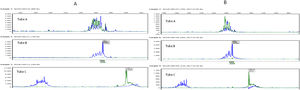 Gráficos del estudio molecular del reordenamiento del gen del receptor TCR beta en lesiones iniciales (A) e inducidas por el test de uso (B). Obsérvese el idéntico pico monoclonal en ambos tubos B y C en las distintas muestras.