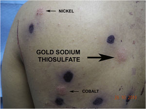Pruebas epicutáneas mostrando intensa positividad para el tiosulfato sódico de oro (placa infiltrada con vesiculación).