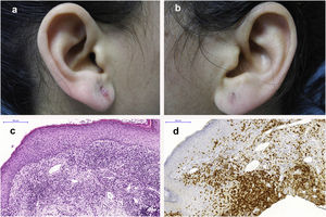 A y B) Lesiones papulosas en idéntica localización aparecidas tras 5 semanas de reexponerse a los pendientes de oro (test de uso); C y D) Idénticos hallazgos en la biopsia de dichas lesiones en tinción H&E e IHQ ×100 que en las figuras 1C y D (lesiones iniciales).