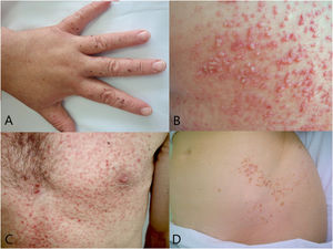 Algunos subtipos de enfermedad de Darier. A) Tipo hemorrágico acro: máculas color rojo oscuro en la cara dorsal de las manos. B) Tipo vesiculoampolloso: vesículas y ampollas de distintos tamaños entremezcladas con unas pápulas eritematoqueratósicas. C) Tipo comedoniano: comedones y quistes junto a las lesiones típicas de enfermedad de Darier. D) Enfermedad de Darier segmentaria tipo 1: afectación limitada a las líneas de Blaschko en el flanco izquierdo.