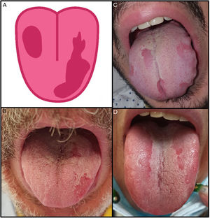 Pacientes con enfermedad por COVID-19 con glositis con depapilación en parches (3,9%). A) Ilustración de la glositis con depapilación en parches observada en pacientes COVID-19. B-D) Pacientes que presentaban glositis con depapilación en parches. Los cultivos para hongos y las serologías fueron negativos.