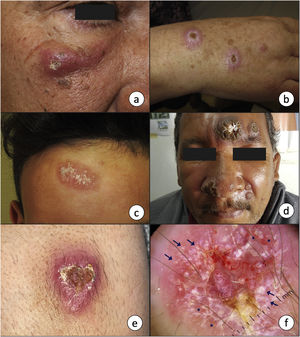 a-c) La presencia de una pápula o nódulo eritematoso de crecimiento progresivo y tendencia a la ulceración en zonas expuestas, como la cara o las extremidades, es la forma de presentación más característica de la leishmaniasis cutánea. d) En ocasiones es posible encontrar varias lesiones en un mismo paciente, así como presentaciones atípicas como la forma verrucosa de la imagen, que se corresponde a una leishmaniasis cutánea del Nuevo Mundo. e) Imagen clínica y f) dermatoscópica de una lesión de leishmaniasis cutánea en el antebrazo que muestra ulceración central rodeada de un área eritematosa con vasos de morfología polimorfa y en horquilla en la periferia (asteriscos), así como estructuras blanco-amarillentas «en lágrima» (flechas) (luz polarizada, ×10). 2c, por cortesía de la Dra. Ana L. Morales Moya; 2d, por cortesía del Dr. Gaston Galimberti; 2e y f, por cortesía de la Dra. Fátima Mayo Martínez.