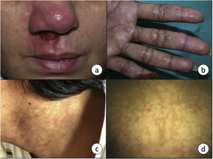 a) La leishmaniasis mucocutánea se manifiesta en forma de una úlcera crónica que frecuentemente afecta a la mucosa nasal. b) Leishmaniasis visceral en un paciente infectado por VIH con afectación cutánea en forma de pápulas firmes en palmas de las manos, y c) máculas hiperpigmentadas en zona cervical. d) Máculas hipopigmentadas como manifestación de una leishmaniasis cutánea post-kala-azar en un niño de 7 años. El diagnóstico se realizó mediante técnicas moleculares, ya que la biopsia fue negativa.