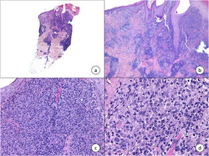 a) Panorámica de biopsia tipo punch de lesión nodular eritematosa localizada en antebrazo (hematoxilina-eosina [H-E], ×5]. b) Presencia de un denso infiltrado inflamatorio dérmico superficial, junto con hiperplasia pseudoepiteliomatosa (H-E, ×10). c) Detalle del infiltrado inflamatorio compuesto mayoritariamente por macrófagos, linfocitos y algunas células epitelioides (H-E, ×20). d) Amastigotes característicos de la infección por Leishmania infestando el interior de los macrófagos (H-E, ×40). Por cortesía de la Dra. Elisa Rios Viñuela.