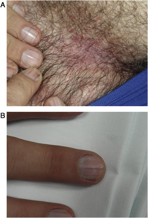 A) Placas eritematosas, carnosas, mal delimitadas, en pliegue inguinal. B) Lesiones presentes en todas las uñas de las manos.