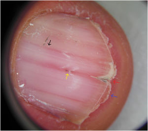 Onicoscopia en la que se aprecian bandas longitudinales de ertitroniquia y leuconiquia dispuestas de forma alterna (flecha negra), hemorragia en astilla bajo la porción central de la lámina (flecha azul), escotadura en V en el borde distal de la lámina ungueal (flecha roja) e hiperqueratosis subungueal (flecha amarilla).