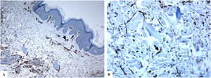 Inmunotinción de CD34 en la piel normal. A) Vasos sanguíneos dérmicos de tamaño variable revestidos por células endoteliales positivas para CD34 (punta de flecha). B) Dendrocitos dérmicos positivos para CD34 (flecha). (Ampliaciones originales. A:×200; B:×400).