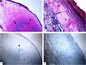Liquen escleroso genital (pene) (balanitis xerótica obliterans del prepucio). A) Las características del LiE peneano incluyen el adelgazamiento de la epidermis con pérdida del patrón normal de las crestas, amplia condensación del colágeno dérmico papilar homogéneo y hialinizado de manera masiva (punta de flecha) y el infiltrado linfocítico dérmico denso y parcheado (flecha). B) Edema, condensación y ondulación de las fibras elásticas (tinción de Verhoeff-van Gieson para fibras elásticas, flecha) en la base del colágeno homogeneizado (estrella). C y D) La tinción de CD34 muestra la pérdida de células dendríticas dérmicas CD34 y un aumento de la densidad de microvasos (estrella). (Ampliaciones originales. A:×20; B:×200; C:×20, y D:×100).