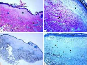 Liquen escleroso extragenital (lesiones mamarias). A) Las características del LiE incluyen la presencia de hiperqueratosis focal, adelgazamiento de la epidermis, hialinización del colágeno dérmico papilar (estrella) y edema. B) Fragmentación y disposición al azar (orientación horizontal, vertical y aleatoria) de las fibras elásticas dérmicas (tinción de Verhoeff-van Gieson para fibras elásticas, flecha). C y D) La tinción CD34 muestra pérdida de células dendríticas dérmicas CD34– y un aumento de la densidad de microvasos (puntas de flecha). (Ampliaciones originales. A:×20; B:×40; C:×20, y D:×40).