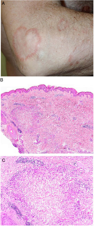 A)Granuloma anular. Paciente que presenta en el brazo varias placas eritematosas anulares de borde ligeramente sobreelevado y aclaramiento central. B)Piel que muestra en la dermis reticular dos áreas de degeneración colagénica y de alteración del intersticio, delimitadas por una reacción inflamatoria dispuesta a modo de banda. La dermis superficial y la epidermis están preservadas. También se observan coronas linfocitarias perivasculares y un incremento difuso de la densidad fibroblástica (H&E ×40). C)Se aprecia una zona central de colágeno desorganizado acompañada de depósito de mucina ácida, que se halla rodeada por un infiltrado de macrófagos, células epitelioides dispuestas en empalizada, fibroblastos, linfocitos y ocasionales eosinófilos. Se reconocen densas coronas linfocitarias perivasculares sin fenómenos de vasculitis (H&E ×200).