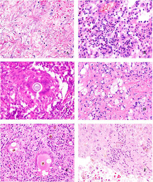 Micosis cutáneas profundas. A)Aspergilosis, H&E ×600. B)Blastomicosis, H&E ×600. C)Coccidioidomicosis, H&E ×600. D)Criptococosis, Mucicarmin ×200. E)Cromoblastomicosis, H&E ×600. F)Feohifomicosis, H&E ×600).
