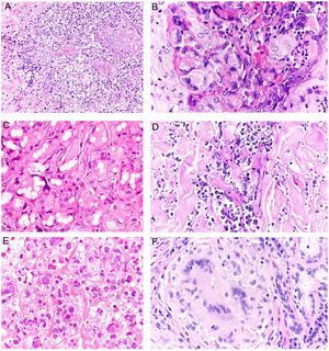 Micosis cutáneas profundas. A)Fusariosis, H&E ×400. B)Histoplasmosis, H&E ×600. C)Lobomicosis, H&E ×600. D)Mucormicosis, PAS ×200. E)Prototecosis, H&E ×600. F)Paracoccidioidomicosis, H&E ×600.