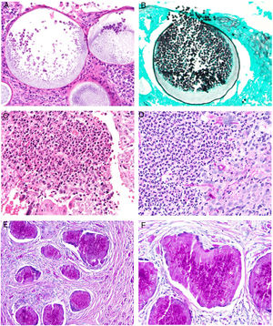 Micosis cutáneas profundas. A,B)Rinosporidiosis (A: H&E, ×400; B: Grocott ×400). C)Esporotricosis (H&E, ×600). D)Alternariosis (PAS ×600). E,F)Eumycetoma (E: PAS ×200; PAS ×600).