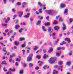 Fenómeno de Splendore-Hoeppli. Se observa un depósito eosinofílico radiado en forma de corona en torno a un organismo de Sporotricum (H&E ×1.000).
