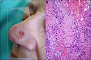 Infección por M.tuberculosis. A)Lesión de lupus vulgar en el dorso nasal (la localización más frecuente) en una paciente con tuberculosis pulmonar. Se aprecia una placa eritematosa formada por varias pápulas, así como el aspecto característico en «jalea de manzana» con la diascopia (Cortesía de la Dra. Sánchez-Aguilar). B)Ejemplo del aspecto histológico de una lesión típica de la tuberculosis: granulomas con necrosis caseosa central y abundantes linfocitos en la periferia (H&E ×40).