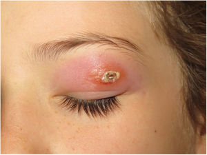 Leishmaniasis cutánea (botón de oriente). Placa eritematosa brillante con edema perilesional y costra central (Cortesía de la Dra. Ana Martin-Santiago, Servicio de Dermatología, Hospital Universitario Son Espases, Palma de Mallorca).