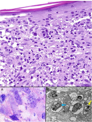 Leishmaniasis. Infiltrado granulomatoso subepidérmico con epidermis atrófica. Presencia de abundantes amastigotes de Leishmania en dermis superior (H&E ×200). Recuadro a: amastigotes intracelulares de 2μm con refuerzo periférico, que tienden a disponerse en la periferia del citoplasma («marquee sign») (HE ×1.000). Recuadro b: microscopia electrónica de transmisión (×8.000), que permite apreciar el núcleo (flecha azul), el quinetoplasto (flecha blanca) y el flagelo interno (flecha amarilla).