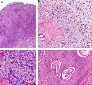 A)Forma crónica de leishmaniasis. Aparecen granulomas epitelioides confluyentes, mal delimitados, de aspecto desordenado («messy granulomas»)48 que suelen ocupar todo el espesor de la dermis (H&E ×20). B)Bilharziosis cutánea tarda vulvar. Zona de dermis reticular en la que se aprecia un granuloma epitelioide con necrosis central alrededor de siete estructuras con morfología redondeada u oval. Una de ellas, más íntegra, muestra una espícula lateral, característica de S.hematobium. C)Prurito del nadador por cercarias. No es una reacción granulomatosa. Se aprecian tres fragmentos longitudinales de Cercaria, sin que se llegara a identificar especie, cercana a glándulas ecrinas y rodeadas de infiltrado linfohistiocitario con numerosos eosinófilos. D)Oncocercoma. Se aprecia infiltrado granulomatoso con presencia de neutrófilos y esclerosis, así como algunas células gigantes de cuerpo extraño alrededor de la sección transversal en tres áreas, con artefacto de retracción característico alrededor de la gruesa cutícula eosinofílica de las tres filarias.