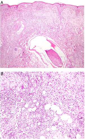 Gnatostomiasis. A)Respuesta granulomatosa frente a la larva (H&E ×20). B)Infiltrados inespecíficos ricos en eosinófilos (H&E ×100).