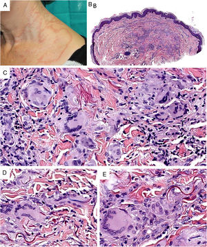 A)Granuloma actínico: grandes placas anulares de bordes sobreelevados eritematosos en área fotoexpuesta. B)La visión panorámica histológica muestra un infiltrado inflamatorio en dermis reticular. C-E)A mayor aumento se aprecia una lesión granulomatosa con numerosas células gigantes multinucleadas y elastofagocitosis, sin empalizada, aumento de mucina ni necrobiosis (B: H&E ×40; C y D: H&E ×400; E: H&E ×600).